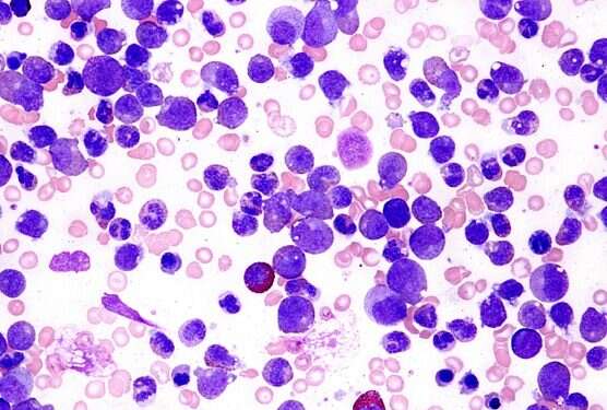 The drug attacks several leukemic proteins at once Israeli researchers develop groundbreaking leukemia drug