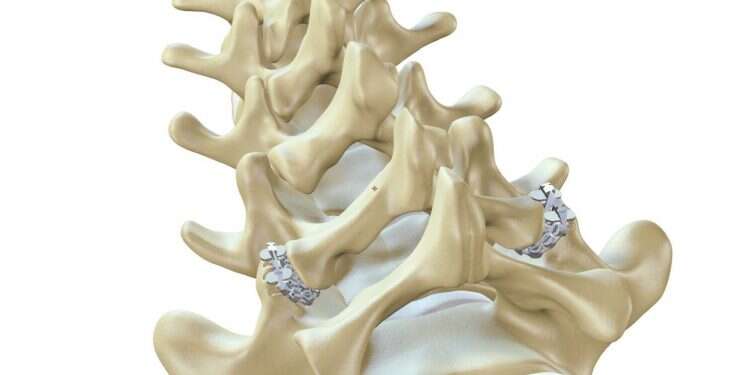 Bye-bye, back pain? Startup's implant could replace current 'gold standard'