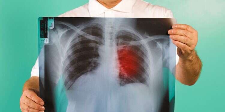 Israeli AI solution beneficial to early detection of certain lung cancer, study finds