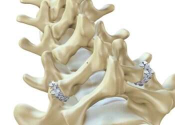 Screwless spinal fusion system from Israel's ZygoFix receives CE mark