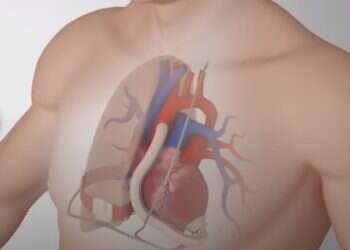An illustration of the Calon-Leviticus fully implantable Ventricular Assist Device Israeli-Welsh collaboration reports success with implantable heart pumps