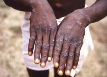 The hands of a monkeypox case patient are seen in this 1997 image Israel confirms communal spread of monkeypox