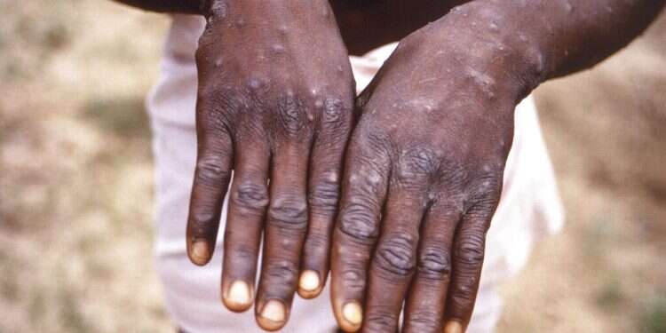 The hands of a monkeypox case patient are seen in this 1997 image Israel confirms communal spread of monkeypox