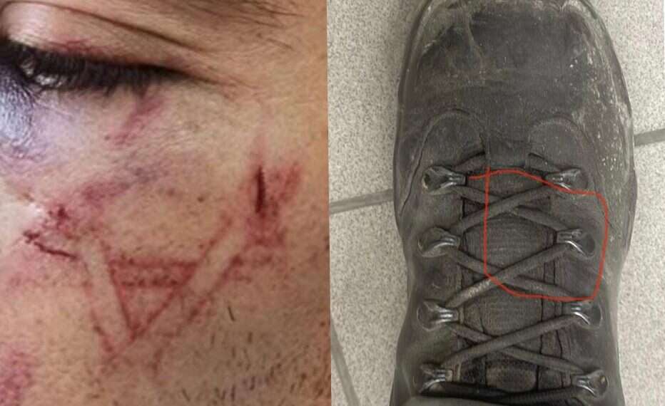 Police deny imprinting Star of David on Palestinian arrestee's face