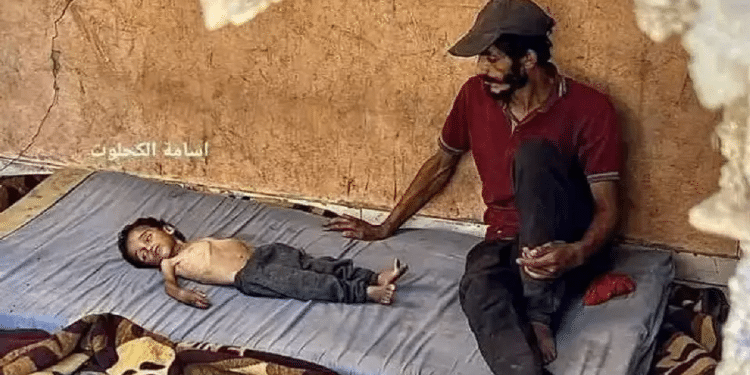 Hamas exploits children with genetic diseases for 'starvation campaign'