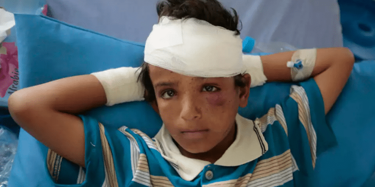 A Yemeni child injured in the bombings in the country The famine no one talks about