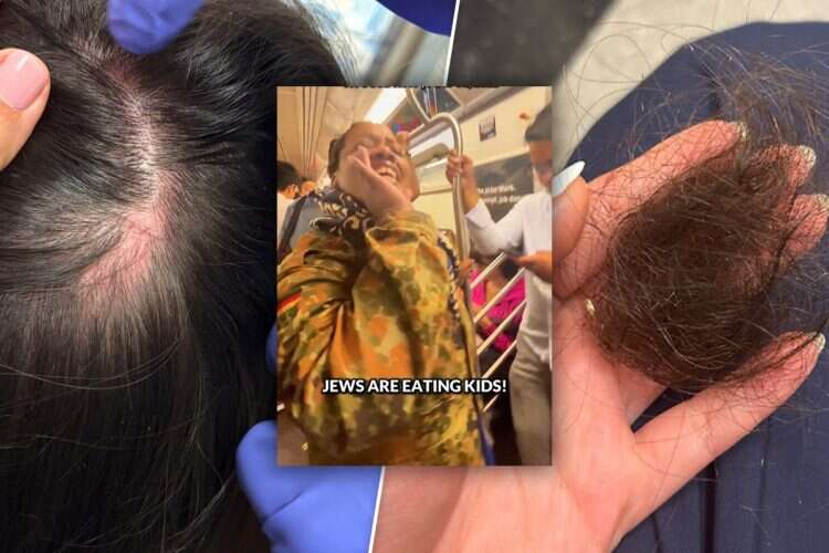 The clump of hair ripped from the victim's scalp during Sunday's C train attack, alongside suspect Diana Smith of the Bronx