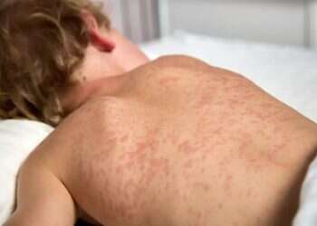 1,000 cases in Pennsylvania, state of emergency declared in New York, measles outbreak hits US New York declares measles emergency amid rural outbreak surge