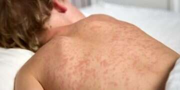 Measles emergency declared in New York as rural cases surge